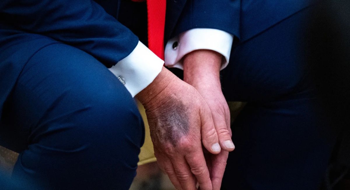 स्वास्थ्यबारे उठेको प्रश्नपछि ट्रम्पको स्पष्टीकरण: ‘मेरो जीवनमै सबैभन्दा राम्रो अवस्थामा छु