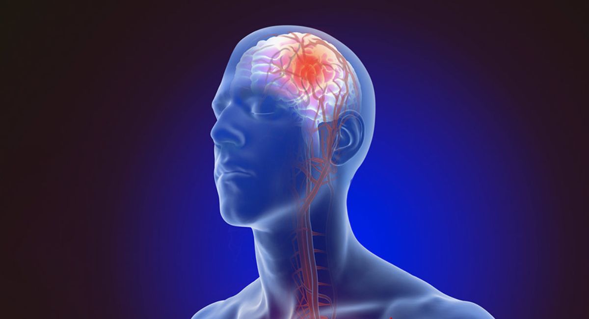 नेपालमा हरेक वर्ष ५० हजारभन्दा बढीलाई मस्तिष्कघात