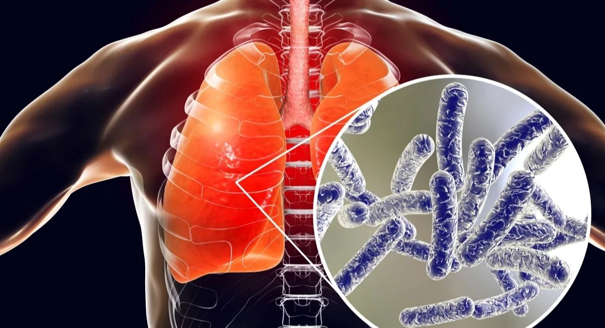 न्युयोर्कमा फैलियो ‘लिजियोनेयर्स’ रोग, ५९ जना बिरामी