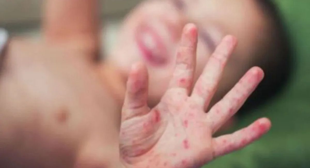 अमेरिकामा दादुराको प्रकोप तीव्र: सङ्क्रमित सङ्ख्या ३ हजार नाघ्यो